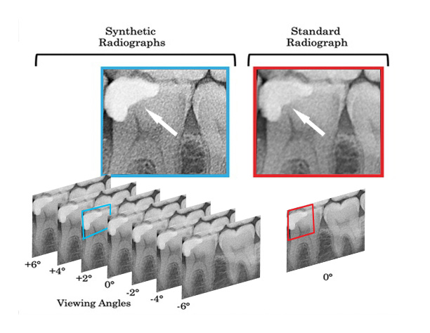 sIOT(Stationary Intraoral Tomosynthesis) 영상