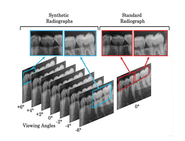 sIOT(Stationary Intraoral Tomosynthesis) 영상